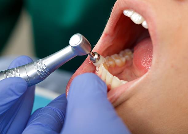 Best Root Canal Treatment  in Delaware, OH